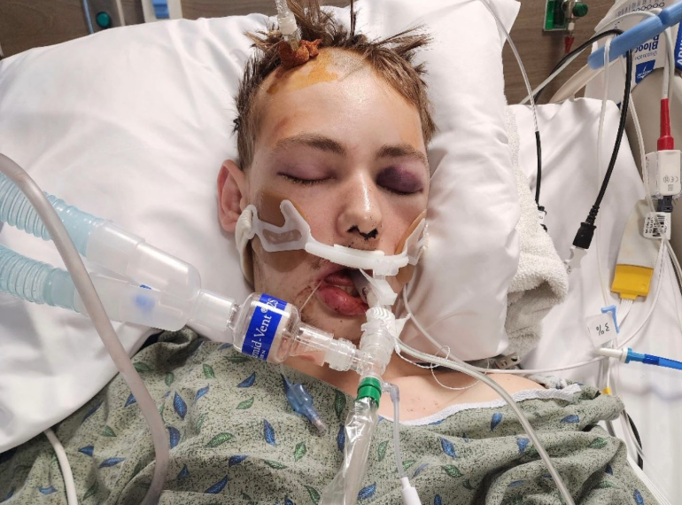 Steven after the accident.